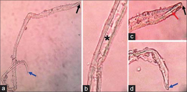 16-year-old boy presented with altered sensorium of 1 day duration diagnosed with eosinophilic meningitis caused by A. cantonensis. (a–d) Images of the microscopic examination of wet mount of CSF ×45 show third-stage larva of Angiostrongylus, knob-like tip (black arrow), rod-like structure (red arrow), intestine (asterisk), and terminal projection on the tip of the tail (blue arrow).