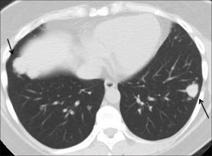 39-year-old woman with pulmonary nodules discovered incidentally diagnosed as pulmonary hyalinizing granuloma associated with idiopathic thrombocytopenic purpura. Lung windows from computed tomography of the abdomen and pelvis demonstrate nodules in the left (red arrow) and right (yellow arrow) lower lobes.