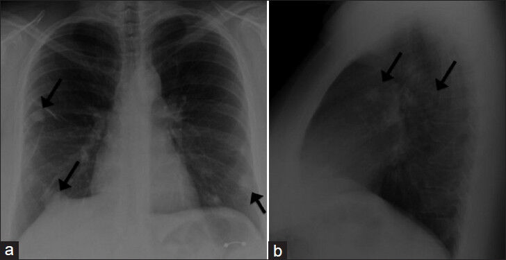 39-year-old woman with pulmonary nodules discovered incidentally diagnosed as pulmonary hyalinizing granuloma associated with idiopathic thrombocytopenic purpura. (a) Posteroanterior (PA) and b) lateral radiographs demonstrate multiple pulmonary nodules (several of which are identified by arrows) bilaterally with relative peripheral and lower lung zone predominance.