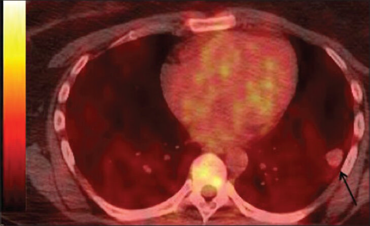 39-year-old woman with pulmonary nodules discovered incidentally diagnosed as pulmonary hyalinizing granuloma associated with idiopathic thrombocytopenic purpura. Fused images from F-18 fluorodeoxyglucose positron emission tomography- computed tomography demonstrate the index lesion without abnormally increased glucose metabolism.