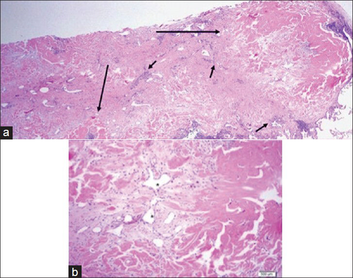 39-year-old woman with pulmonary nodules discovered incidentally diagnosed as pulmonary hyalinizing granuloma (PHG) associated with idiopathic thrombocytopenic purpura. a) ×10 magnified H and E, stained microscopy of the two nodules from wedge resection (long arrows) shows clusters of lymphoplasmacytic infiltrate (short arrows) peripherally. b) ×20 magnified view demonstrates whirled layers of collagen (dark pink) around small blood vessels (*), consistent with PHG. No multinucleated giant cells are present.