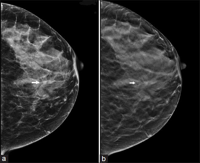 42-year-old asymptomatic woman presents for routine screening with combination digital breast tomosynthesis plus full field digital mammography (a) Full field digital mammography craniocaudal view demonstrates a possible area of architectural distortion (arrow). (b) Digital breast tomosynthesis slice demonstrates the area of architectural distortion more definitively (arrow). Biopsy result was invasive ductal carcinoma.