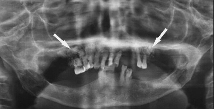 Cotton Wool” Appearance of Paget's Disease