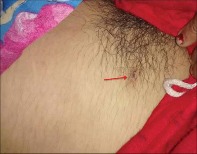 18-year-old adult female who presented to the emergency department in an unconscious state with fever and rash was diagnosed with scrub typhus. The photograph of the patient shows presence of eschar on the right side of the pubic region (red arrows).