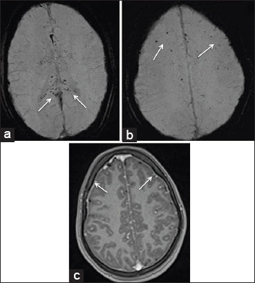 18-year-old adult female who presented to the emergency department in an unconscious state with fever and rash was diagnosed with scrub typhus. (a and b) SWI images of MRI brain show multiple petechial hemorrages in the splenium and body of corpus callosum (white arrows in 2a) and in the subcortical white matter (white arrows in 2b). (c) Post-contrast MP RAGE axial image shows enhancement of pachymeninges along the frontal lobe bilaterally (white arrows).