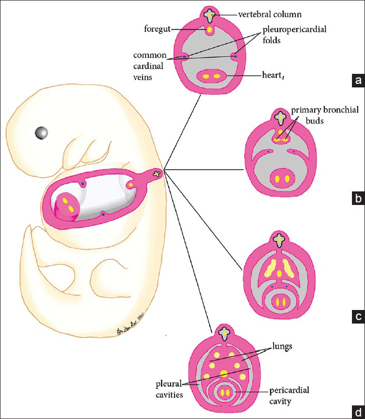 Illustration of normal pericardial development from the fourth to sixth week of gestation. (a) At 4 weeks of gestation, the laterally positioned pleuropericardial folds are developed. (b) During the 5th week of gestation, the pleuropericardial folds grow toward the midline while the root of each fold migrates ventrally. (c) At the end of the 5th week, the pleuropericardial folds fuse, partitioning the thoracic cavity into a pericardial cavity and two partially formed pleural cavities. Note that union of the pleuropericardial folds and the root of the lungs also occurs during this time. (d) The lungs continue to extend anteriorly to the front of the heart.