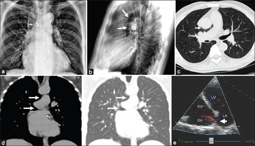 77-year-old man with dyspnea. (a) PA chest radiograph reveals a slightly more horizontal ascending aorta due to partial herniation of the ascending thoracic aorta through a pericardial defect (arrow). (b) Lateral radiograph demonstrates abnormal lucency between the ascending aorta and the right pulmonary artery (arrows) resulting in an unusually dense-appearing and prominent right pulmonary artery (RPA). (c) Transaxial CT imaging with lung window confirms this lucency which represents the lung interposed between the aorta and the pulmonary artery through a partially absent right pericardium (arrow), producing the characteristic “retroaortic air” sign. (d) Coronal reformatted images with soft tissue and lung windows demonstrate air insinuating beneath both the aorta and the pulmonary artery (arrows). The right lung resembles the head and body of an open-mouthed dolphin. (e) Right pericardial absence has been associated with other congenital cardiac defects. Echocardiography demonstrates a secundum type atrial septal defect with left to right shunting (arrow).