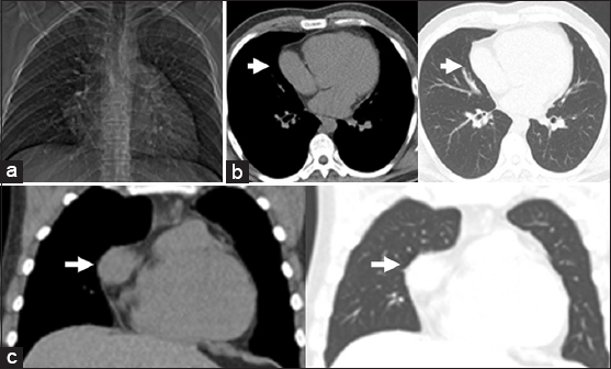 26-year-old man evaluated following an environmental exposure. (a) Scout view demonstrates a bulging right heart border. (b) Transaxial and (c) Coronal CT images confirm partial right pericardial absence. Part of the right atrial appendage extends laterally through the partial defect (arrow).