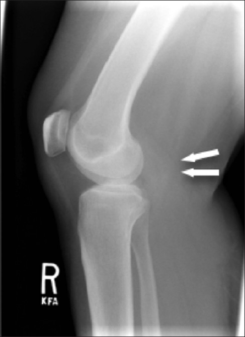 55-year-old female with right posterior calf pain diagnosed with tenosynovial giant cell tumor. Lateral radiograph of the knee reveals soft tissue fullness in the popliteal fossa (arrow).