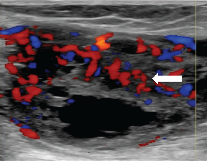 55-year-old female with right posterior calf pain diagnosed with tenosynovial giant cell tumor. Ultrasound of the soft tissue mass demonstrates solid and cystic components. Doppler ultrasound shows prominent vascularity within the solid, echogenic components of the lesion (arrow).