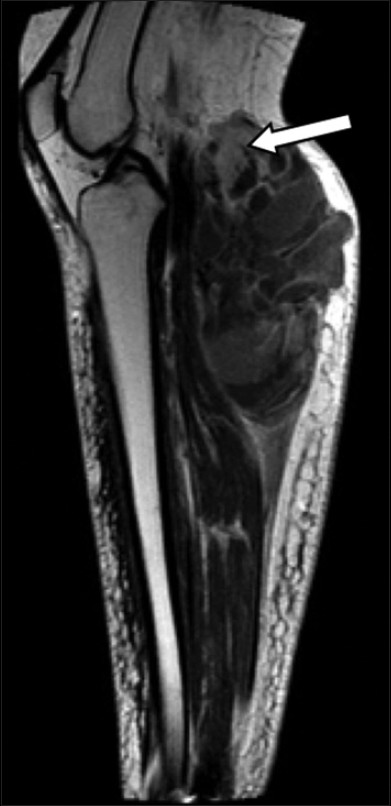 55-year-old female with right posterior calf pain diagnosed with tenosynovial giant cell tumor. Sagittal T1-weighted MR post-contrast imaging reveals enhancement of solid areas (arrow).