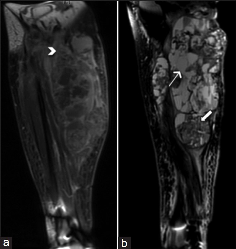 55-year-old female 7 weeks post-resection of tenosynovial giant cell tumor with complaints of pain and friable tissue growth at the incision site. (a) Coronal T1-weighted post-contrast MRI of the right knee shows a heterogeneous lobulated lesion extending to the mid-calf. The lesion measures 24.4 cm in craniocaudal dimension. Margins of soft tissue components of the lesion are ill-defined and somewhat infiltrative in some areas (arrowhead). (b) Sagittal T2-weighted MR of the right knee shows both cystic (thick arrow) and solid (thin arrow) areas within the heterogeneous lesion.