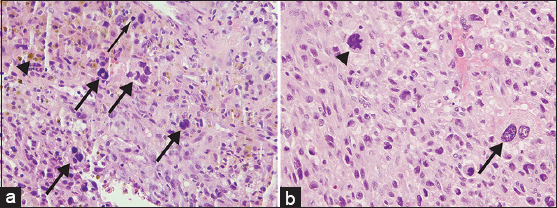 55-year-old female with right posterior calf pain initially diagnosed with tenosynovial giant cell tumor with subsequent resection demonstrating malignant tenosynovial giant cell tumor. Pathology of core biopsy and resection specimens is shown. (a) Core biopsy sample of the mass stained with Hematoxylin and eosin, ×400, shows epithelioid cells with round nuclei and a background of lymphocytes, histiocytes, several multinucleated giant cells (thick arrows), and scattered mitoses (thin arrow). Hemosiderin is also present (arrowhead). (b) Although the majority of the resection specimen appears similar to the core biopsy, select areas of the resection stained with Hematoxylin and eosin (×400), display pleomorphic cytology with large, highly atypical cells (arrow) and atypical mitoses (arrowhead), consistent with the diagnosis of malignant diffuse-type TGCT.