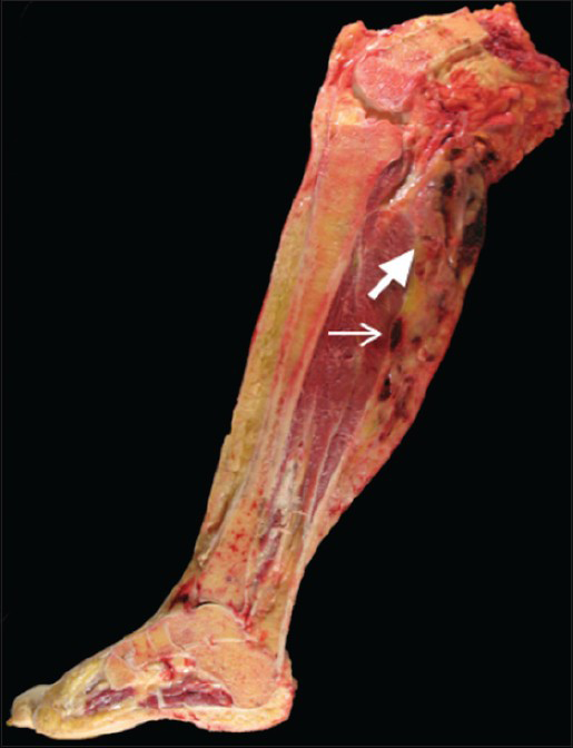 Malignant Tenosynovial Giant Cell Tumor Of The Leg A Radiologic