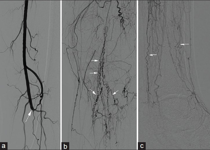 44-year old male patient with sudden onset of pain in left leg and ulcer on the toe, diagnosed with Buerger's disease. Baseline digital substraction angiography of (a and b) the popliteal region and (c) leg demonstrates abrubt thromboembolic occlusion of the popliteal artery (large white arrow in a). Typical corkscrew collateral arteries (small white arrows in b and c) and occlusion of the run-off vessels in concordance with Buerger's disease before intervention.