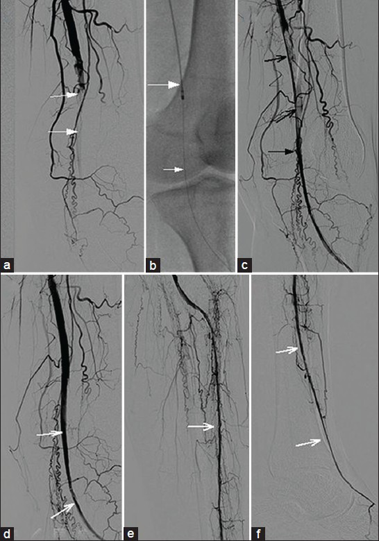 44-year-old male patient with sudden onset of pain in left leg and ulcer on the toe, diagnosed with Buerger's disease. Digital substraction angiography of (a–d) the popliteal region and (e and f) leg during mechanical thrombectomy of the distal popliteal artery with Rotarex and reconstruction of flow to the foot. (a) Complete occlusion of the popliteal artery above the knee joint involving the trifurcation and all three lower limb artery origins (white arrows). (b) 6F Rotarex catheter (large white arrow) over the 0.018-inch wire (small white arrow). (c) Partial removal of the thrombus (open black arrows) and recanalization of the popliteal artery (black arrow) after retrograde re-entry to the true lumen following dorsalis pedis access (not shown). (d) Using the rotarex catheter, the clot was destroyed and removed totally. Patent anterior tibial artery is visible (white arrows). (e and f) Flow was reconstructed to the foot via anterior tibial artery (white arrows).