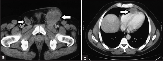 40–year-old male presented with a lesion over the glans penis diagnosed as carcinoma penis. Contrast enhanced CT of (a) abdomen axial view reveals bilateral inguinal nodes (arrows) and of (b) chest shows cardiac lesion (arrow) suggestive of metastatic disease.