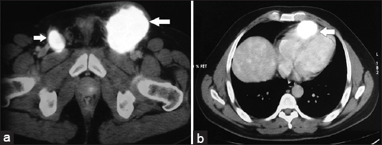 40–year-old male presented with a lesion over the glans penis diagnosed as carcinoma penis. PET CT scan of the patient reveals intense FDG uptake lesion in (a) pelvic region by the bilateral inguinal nodes (arrows) and in the (b) chest region by the cardiac lesions (standardised standardized uptake value - 9.8) suggestive of metastatic disease.