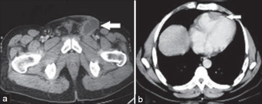 40–year-old male presented with a lesion over the glans penis diagnosed as carcinoma penis. After six cycles of chemotherapy contrast enhanced CT of the (a) pelvic region shows partial response in the bilateral inguinal nodes (arrows) and (b) CECT chest shows reduction the cardiac lesion (arrow).