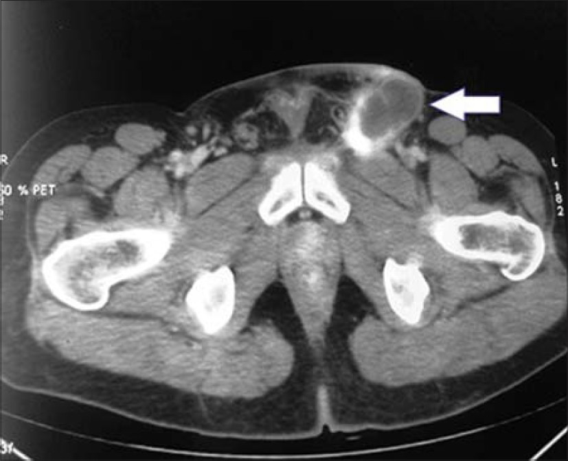 40–year-old male presented with a lesion over the glans penis diagnosed as carcinoma penis. Post chemotherapy PET CT scan shows minimal FDG uptake in left inguinal node (arrow) and disappearance of right inguinal nodes suggestive of partial response.