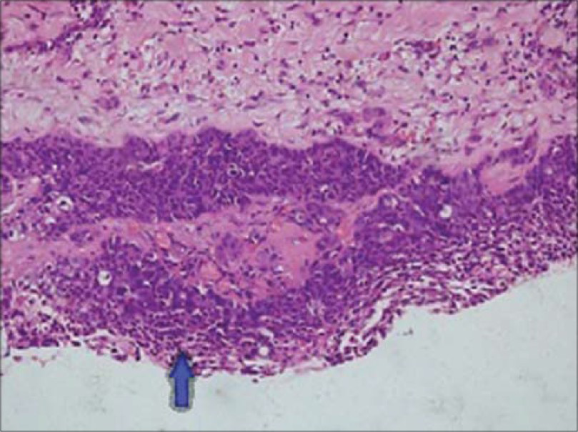 40–year-old male presented with a lesion over the glans penis diagnosed as carcinoma penis. Histopathology slide of pericardial tissue stained with hematoxylin and eosin (10× magnification) shows islands and nest of cells surrounded by desmoplastic stroma (arrow) and immunopositivity with PAN – cytokeratin.