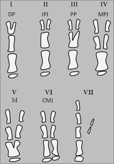 Types of thumb duplication and level of bifurcation according to Wassel's classification. DP = Distal phalanx, IPJ = Interphalangeal joint, PP = Proximal phalanx, MPJ = Metacarpophalangeal joint, M = Metacarpal, and CMJ = Carpometacarpal joint.