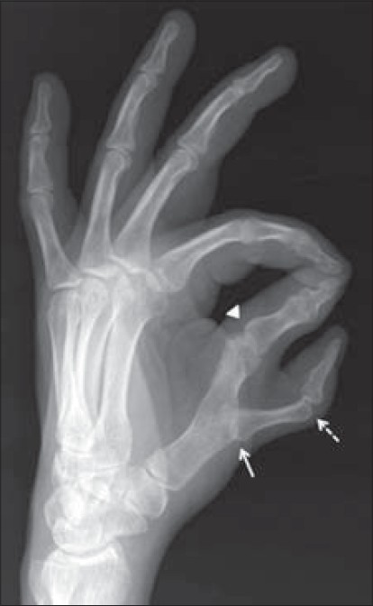 42-year-old man with isolated left-hand duplicated thumb. Plain radiographic image shows duplicated phalanges with bifid first metacarpal. Swan neck deformity is observed as hyperextension of metacarpophalangeal joint (white arrow) and flexion deformity of interphalangeal joint (dotted arrow). Ulnar-side thumb is articulated with the metacarpal head and has flexion deformity of interphalangeal and metacarpophalangeal joints (arrowhead).