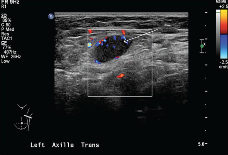 46-year-old female with history of neurofibromatosis Type 1 presented with left breast mass diagnosed as metaplastic breast carcinoma. Ultrasound of the left axilla showed an enlarged axillary lymph node (arrow) with eccentric thickened cortex.
