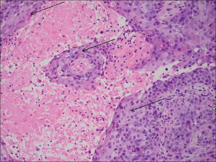 46-year-old female with history of neurofibromatosis Type 1 presented with left breast mass diagnosed as metaplastic breast carcinoma. Microscopic examination of the core biopsy (hematoxylin and eosin stain, ×200) reveals solid sheets of neoplastic cells with squamous differentiation (arrows), diagnostic of metaplastic breast carcinoma with keratinizing squamous histology.