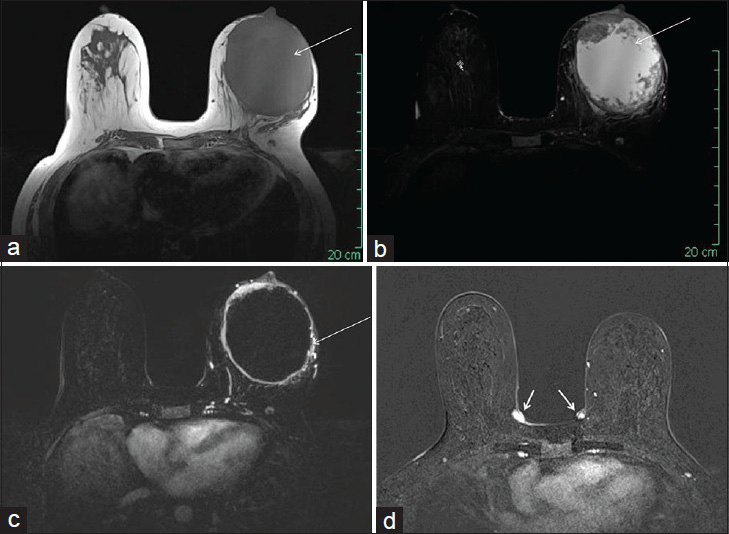 46-year-old female with history of neurofibromatosis Type 1 presented with left breast mass diagnosed as metaplastic breast carcinoma. Breast MRI with (a) T1-weighted, (b) short tau inversion recovery (STIR), and (c and d) subtraction post-contrast images demonstrate a large mass (long arrows) in the central left breast with low T1 (a), high T2 (b), and rim-like enhancement (c). Small enhancing nodules (neurofibromas) (short arrows) are also noted at the skin of the left breast, consistent with patient's known neurofibromatosis (d).