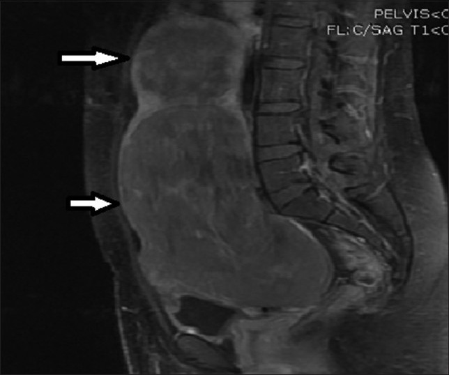 28-year-old female presenting with menorrhagia and pelvic mass. Post-contrast T1-weighted sagittal MRI image before UFE reveals two enhancing fibroids (solid arrows).