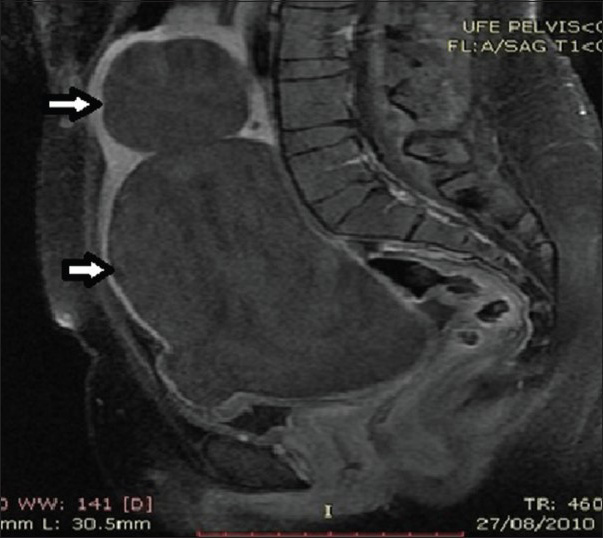 28-year-old female presenting with menorrhagia and pelvic mass. Follow-up MRI post UFE, the fibroids demonstrate loss of enhancement (arrows), but no significant change in volume.