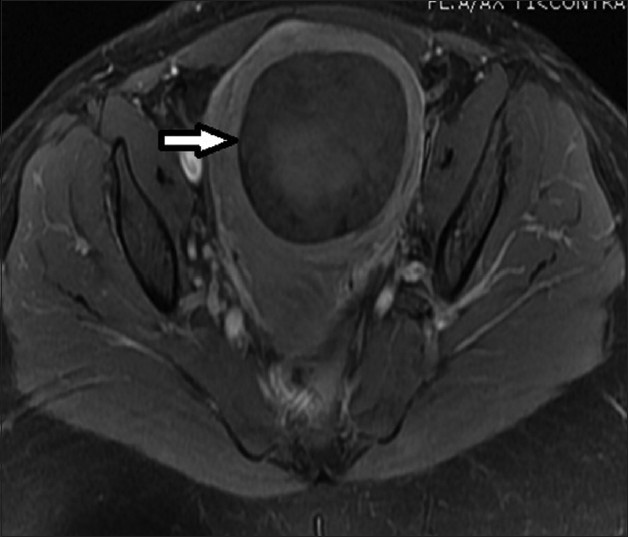 33-year-old female presenting with mild pelvic pain and a palpable pelvic mass. T1-weighted axial MRI image before UFE shows a single intramural fibroid with heterogeneous (mild/moderate) enhancement pattern.