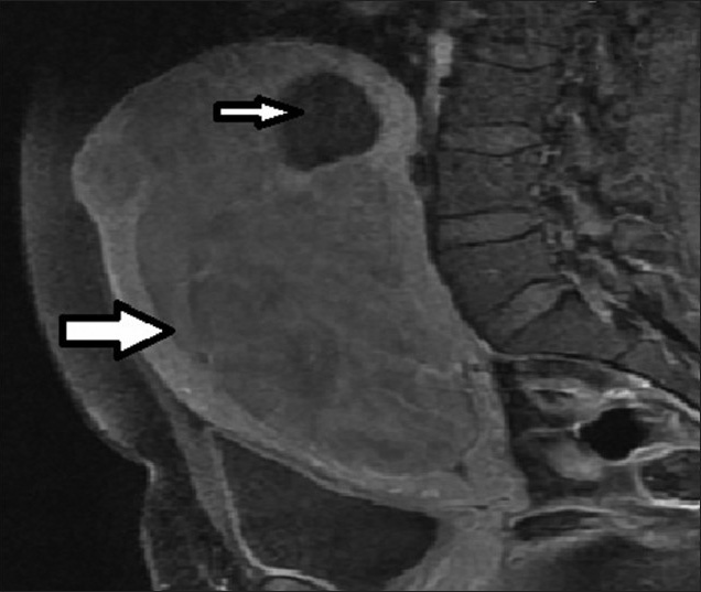 36-year-old female presenting with pelvic mass, lower abdominal pain, infertility, and menorrhagia. T1-weighted sagittal MRI image before UFE reveals a large enhancing fibroid (thick arrow) and a small non-enhancing fibroid (thin arrow).