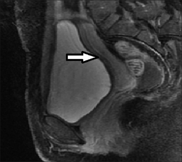 36-year-old female presenting with pelvic mass, lower abdominal pain, infertility, and menorrhagia. Follow-up MRI post UFE shows the fibroids has completely regressed (arrow).