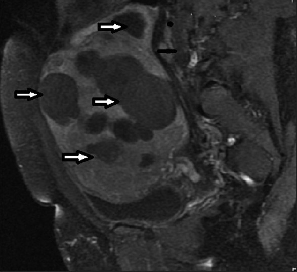 34 year old female presenting with heavy menses. T1-weighted sagittal post-contrast MRI image before UFE shows bulky uterus with multiple fibroids (arrows).