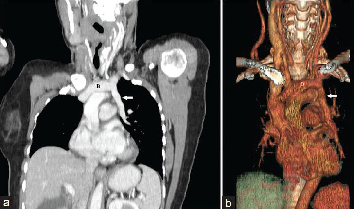 59-year-old female with endometrial carcinoma. (a) Oblique multiplanar reconstruction (MPR) image and (b) volume-rendered (VR) image demonstrate the left upper lobe pulmonary vein (arrow) draining into the left brachiocephalic vein.