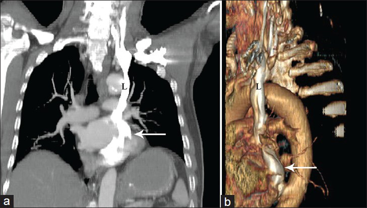 66-year-old male with cholangiocarcinoma. (a) Oblique coronal maximum intensity projection (MIP) image and (b) volume-rendered (VR) and VR image demonstrate a persistent left superior vena cava (L) draining into the coronary sinus (arrow).