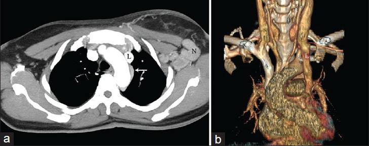 47-year-old female with carcinoma breast. (a) Axial maximum intensity projection (MIP) and (b) volume-rendered (VR) images demonstrate persistent left superior vena cava (SVC) (L). On the axial image, a left hemi-azygous vein (arrow) is noted draining into the left SVC. Also seen are enlarged left axillary lymph nodes (N).