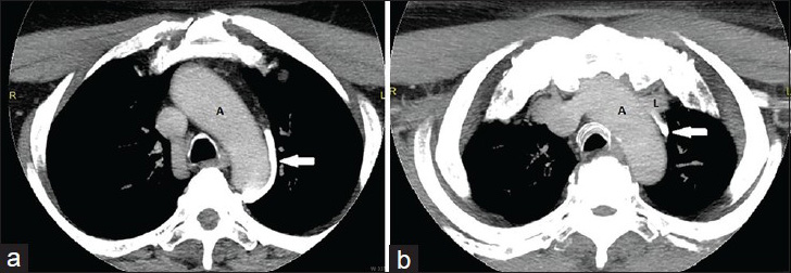 45-year-old male patient with carcinoma tongue. (a and b) Axial contrast-enhanced CT (CECT) maximum intensity projection (MIP) images demonstrate the left superior intercostal vein (arrow) coursing along the arch of aorta (A) to drain into the left brachiocephalic vein (L).