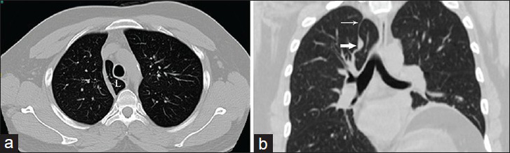 40-year-old male patient with laryngeal carcinoma. (a) Axial non-contrast CT (NCCT) lung window image demonstrates the azygous lobe (L). (b) Coronal NCCT lung window image displays the entrapped vein in cross section (bold arrow with pleural layers forming a sling (thin arrow).