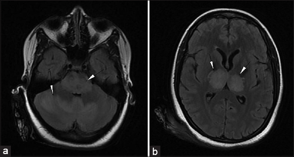 23-year-old female presented with headache and fever was diagnosed with acute necrotizing encephalopathy. Axial FLAIR MR images (a) at the level of pons and cerebellum show hyperintense signals (arrowheads) in the pons and cerebellum and (b) at the level of thalami shows hyperintense signals in bilateral thalami (arrowheads).