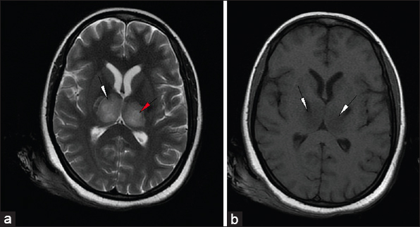 23-year-old female presented with headache and fever was diagnosed with acute necrotizing encephalopathy. Axial (a) T2-weighted (T2W) and (b) T1-weighted images at the level of thalami show hyperintense signal in bilateral thalami and the posterior limb of internal capsule on T2W (white arrowheads) and hypointense signal on T1-weighted images (arrowhead). T2W image shows increased signal (red arrowhead) in the center representing necrosis.