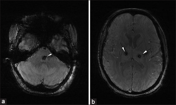 23-year-old female presented with headache and fever was diagnosed with acute necrotizing encephalopathy. Axial gradient images (a) at the level of pons and (b) thalami show blooming representing hemorrhages (white arrowheads) in bilateral thalami and the pons.