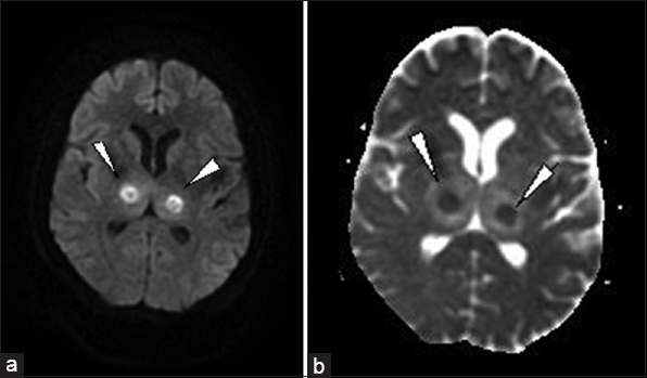 23-year-old female presented with headache and fever was diagnosed with acute necrotizing encephalopathy. (a) Axial diffusion and (b) apparent diffusion coefficient images show restrictions (arrowheads) representing necrosis and hemorrhages. Note the areas of hemorrhage are small compared to necrosis on diffusion images, suggesting coexisting hemorrhage and necrosis.