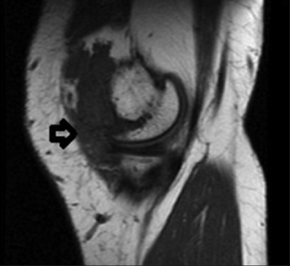 23-year old male with swelling and pain in his knee which was subsequently diagnosed as synovial hemangioma. Sagittal T1 weighted spin echo (SE) image shows hypointense intra-articular nodular soft tissue mass filling medial suprapatellar bursa, extending into the vastus medialis (arrow).