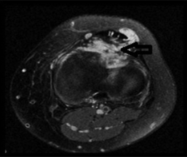 23-year old male with swelling and pain in his knee which was subsequently diagnosed as synovial hemangioma. Coronal proton density fat-suppressed image shows the mass lesion with heterogeneous signal containing fibrous septa and irregular margin (arrow).