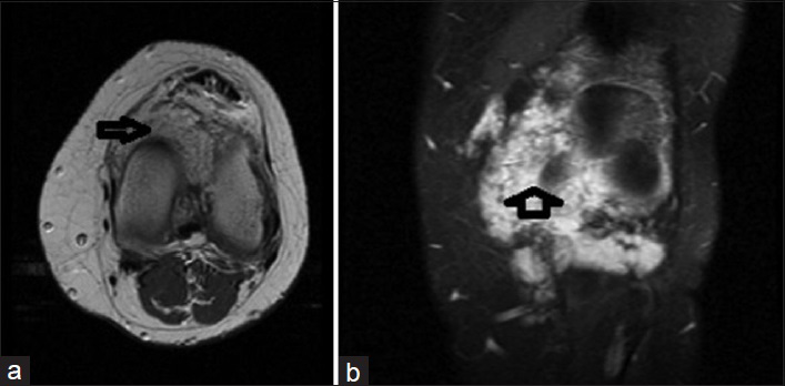 23-year old male with swelling and pain in his knee which was subsequently diagnosed as synovial hemangioma. (a) Axial T1 SE and (b) coronal T1 fat-suppressed images show diffuse contrast enhancement (arrow).