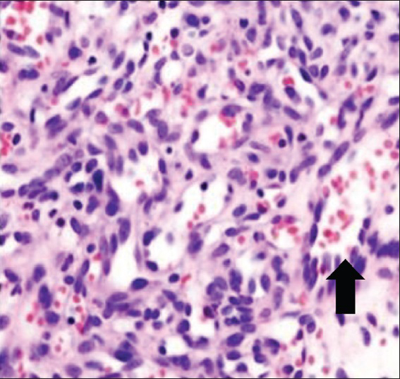 23-year old male with swelling and pain in his knee which was subsequently diagnosed as synovial hemangioma. Biopsy tissue stained with hematoxylin and eosin ×100 shows hemangioma in the arthroscopic biopsy (arrow).