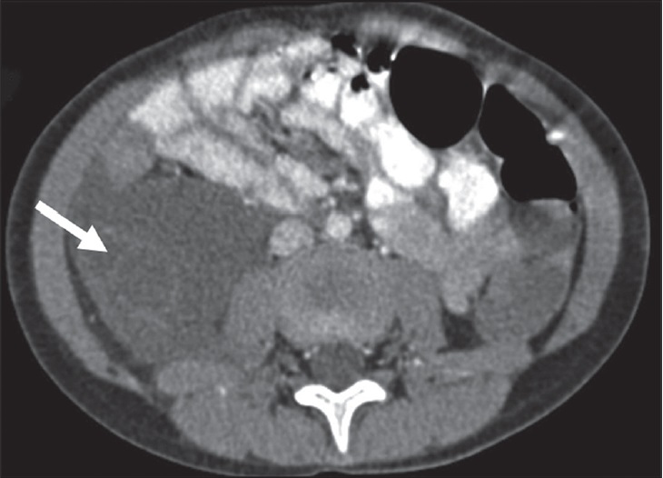 5-year-old girl with right-side abdominal distension diagnosed as cystic lymphangioma on surgery. Post-contrast axial CT image shows a smooth-contoured retroperitoneal mass lesion with fluid density. Note that there are also thin enhancing septa (arrow) in the caudal portion of lymphangioma.